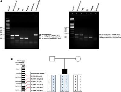 Case Report: An Atypical Angelman Syndrome Case With Obesity and Fulfilled Autism Spectrum Disorder Identified by Microarray